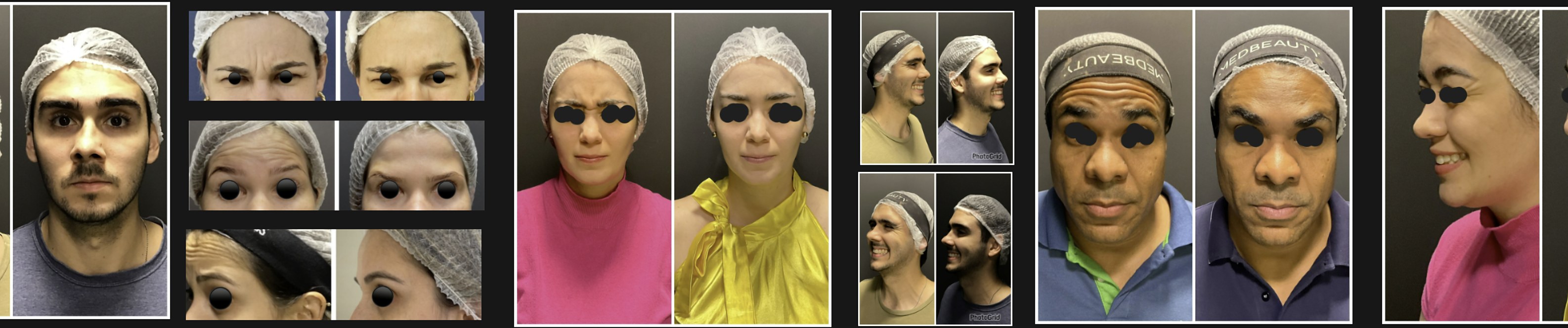Resultados antes e depois